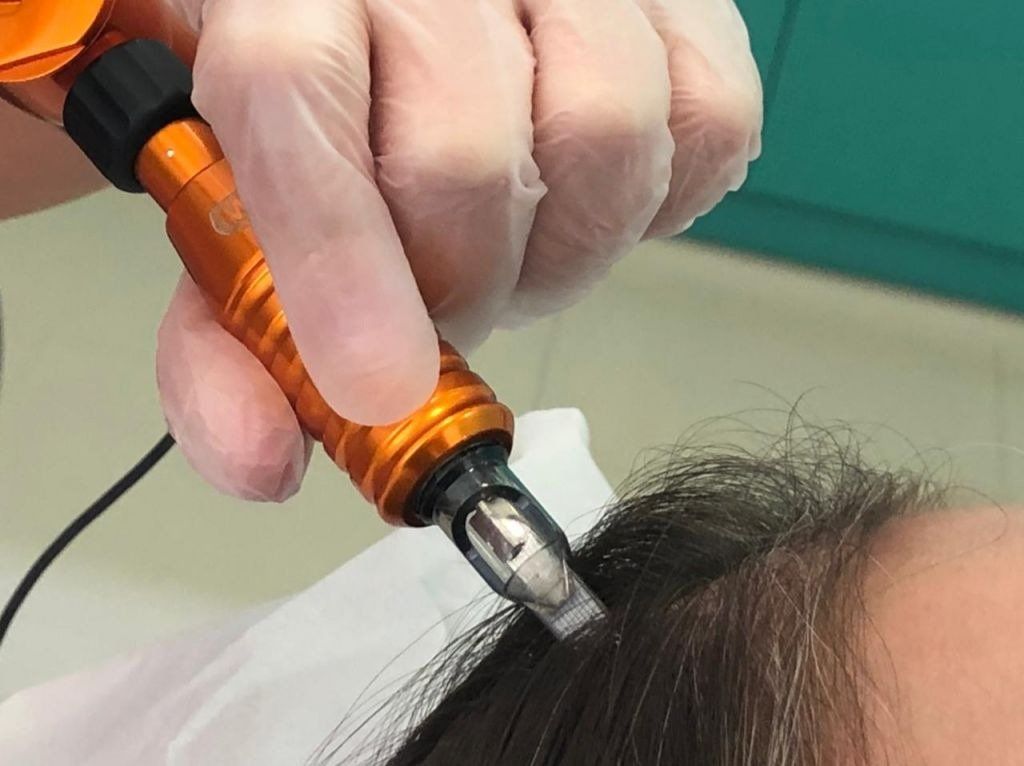 Microinfusão de Ativos